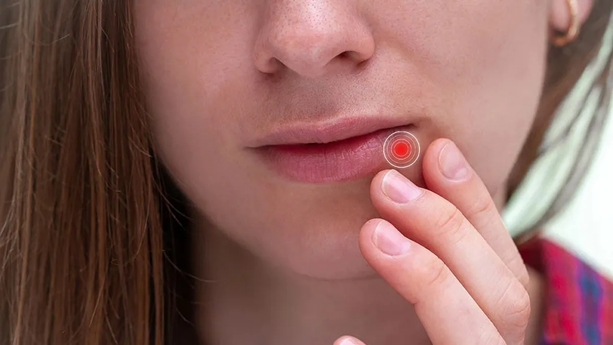 Чому з’являється герпес на губах: як його швидко вилікувати та що провокує рецидив