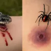 Вкусила змія чи павук? Не панікуй — ось що треба зробити негайно