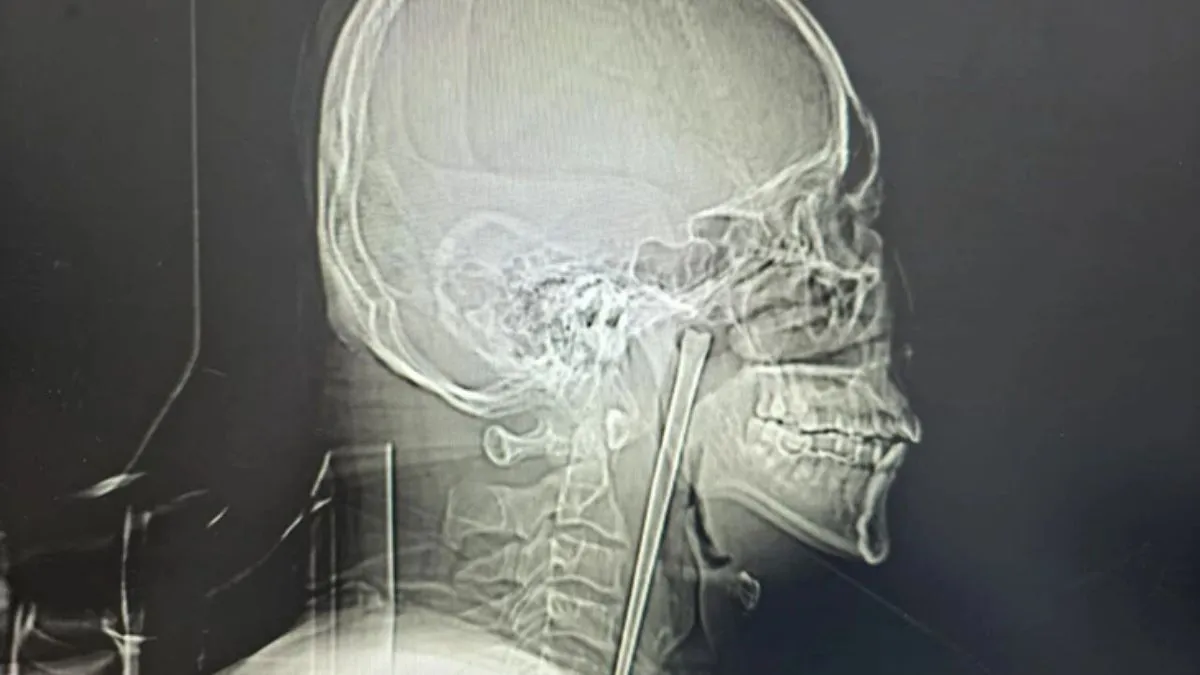 У Китаї чоловік жив 8 років з 12-сантиметровим предметом в горлі: що він запхав до рота