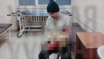 В Одесі молодик намагався відтяти собі руку, щоб уникнути мобілізації: хотів отримати інвалідність