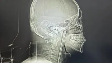 У Китаї чоловік жив 8 років з 12-сантиметровим предметом в горлі: що він запхав до рота