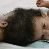 У США розділили дворічних сіамських близнючок, з’єднаних головами: деталі унікальної операції