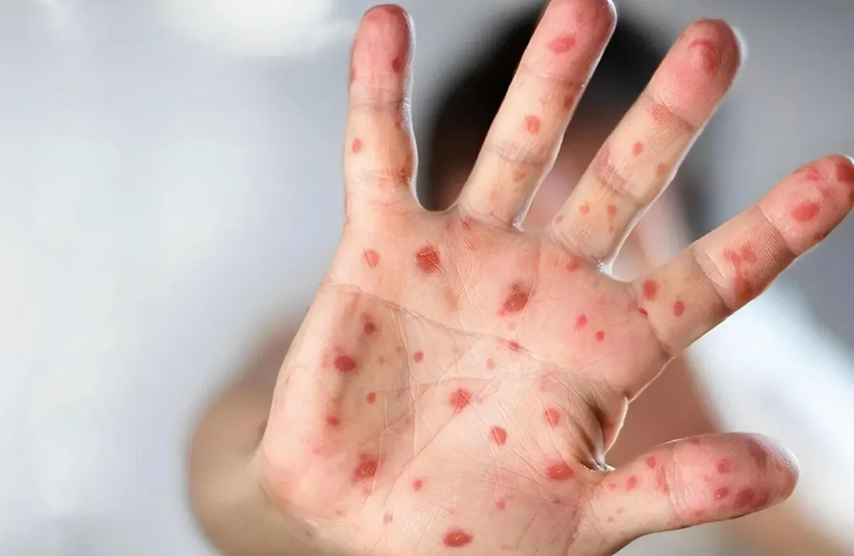 вірус, коксакі