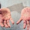 На Київщині зафіксовано спалах ЕСНО-вірусу: що відомо про захворювання, яке переважно уражає дітей