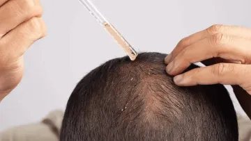 Попрощатися з облисінням за 20 днів цілком реально: вчені знайшли спосіб стимулювати ріст волосся