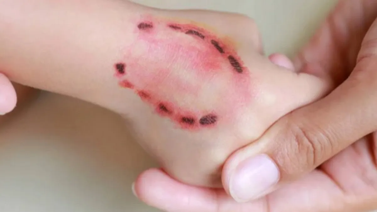 У Львові від сказу померла жінка, яку вкусило на кладовищі кошеня: як вберегтися від летального захворювання