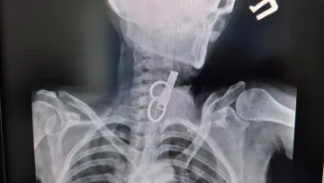 Ключі від дверей застрягли у стравоході жінки: лікарі провели унікальне втручання на Тернопільщині