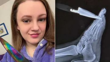 Фатальна випадковість, що стала порятунком: жінка встромила ніж у ногу та дізналася про страшний діагноз