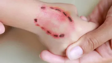 У Львові від сказу померла жінка, яку вкусило на кладовищі кошеня: як вберегтися від летального захворювання