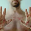 Мавпяча віспа слідом за чумою в Росії: госпіталізували п’ятьох людей після контакту з імовірно інфікованим